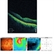 Reduced Cistoid Macular Edema (CME)  after Anti VEGF Treatment